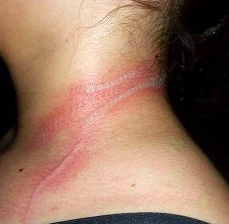 She looked at her little girl and saw these wounds on her neck.