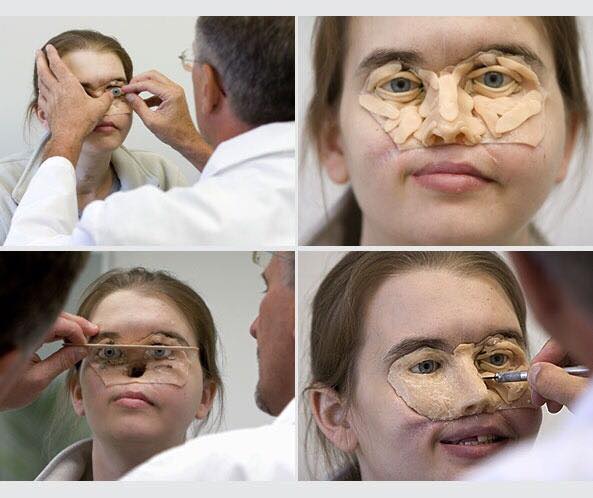 She lost half her face in 1999, now her doctors have finally given her a reason to remove the mask