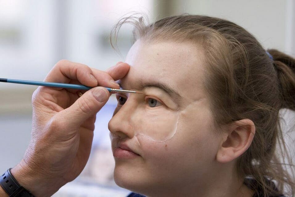 She lost half her face in 1999, now her doctors have finally given her a reason to remove the mask