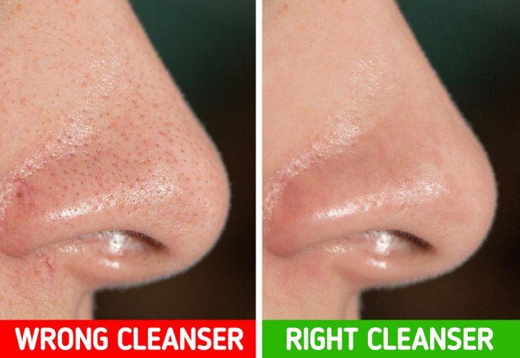 Clogged pores, genetics, age, and sun damage are the main causes of enlarged pores.