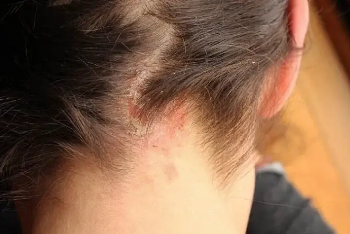 Found this on my son’s scalp. Have no idea what it is and we can’t get a doc appt soon. Tips? Found this on my son’s scalp. Have no idea what it is and we can’t get a doc appt soon. Tips?