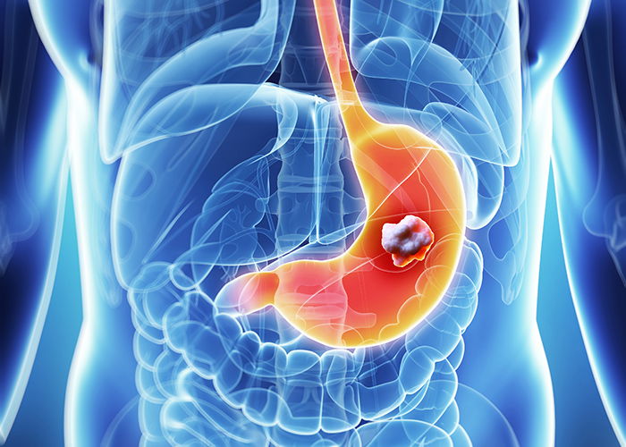 5 early signs of can.cer growth in the body 5 early signs of can.cer growth in the body