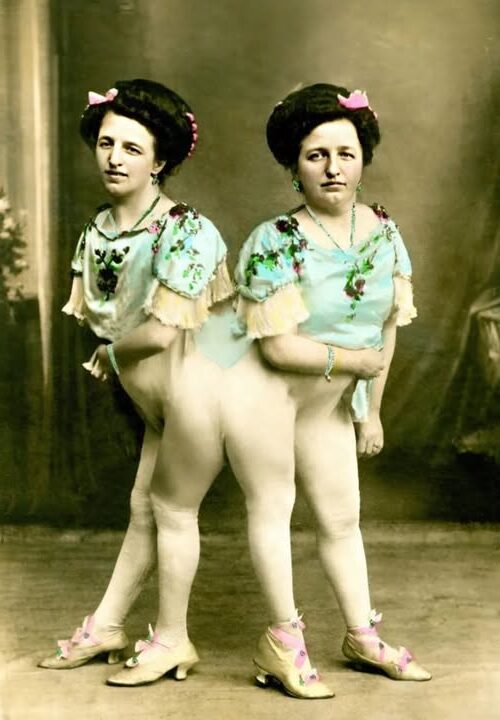 The Incredible Story of the Siamese Twins: One Fell in Love, Had a Baby — and Both Became Mothers… The Incredible Story of the Siamese Twins: One Fell in Love, Had a Baby — and Both Became Mothers…