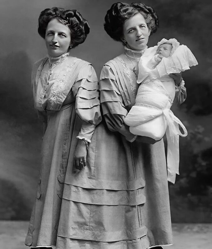 The Incredible Story of the Siamese Twins: One Fell in Love, Had a Baby — and Both Became Mothers… The Incredible Story of the Siamese Twins: One Fell in Love, Had a Baby — and Both Became Mothers…