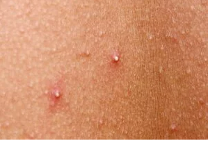 RED DOTS ON YOUR SKIN: CAUSES AND WHAT THEY MIGHT REPRESENT