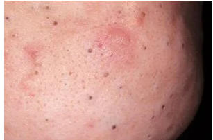 RED DOTS ON YOUR SKIN: CAUSES AND WHAT THEY MIGHT REPRESENT
