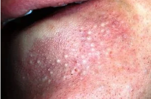 RED DOTS ON YOUR SKIN: CAUSES AND WHAT THEY MIGHT REPRESENT