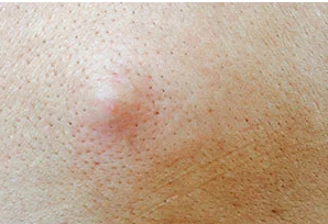 RED DOTS ON YOUR SKIN: CAUSES AND WHAT THEY MIGHT REPRESENT