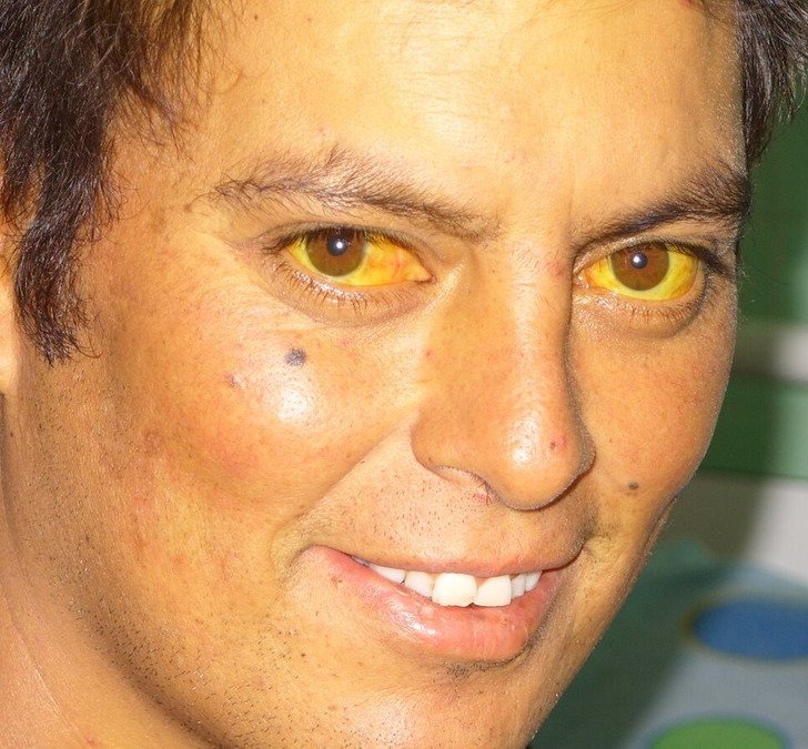 12 Unusual Eye Changes That Might Predict Serious Health Issues 12 Unusual Eye Changes That Might Predict Serious Health Issues