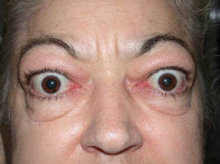 5. Loss of peripheral vision.