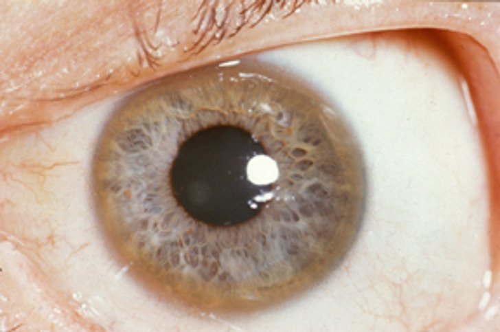 5. Loss of peripheral vision.
