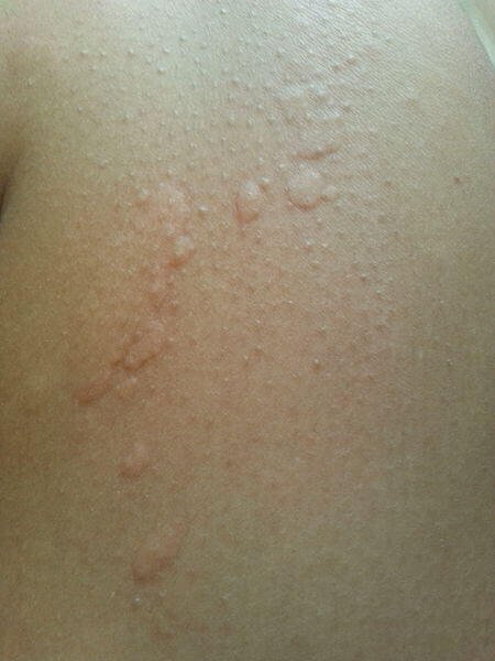 Cold Urticaria: Symptoms And Treatment Cold Urticaria: Symptoms And Treatment