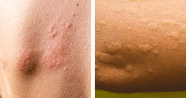 Cold Urticaria: Symptoms And Treatment Cold Urticaria: Symptoms And Treatment