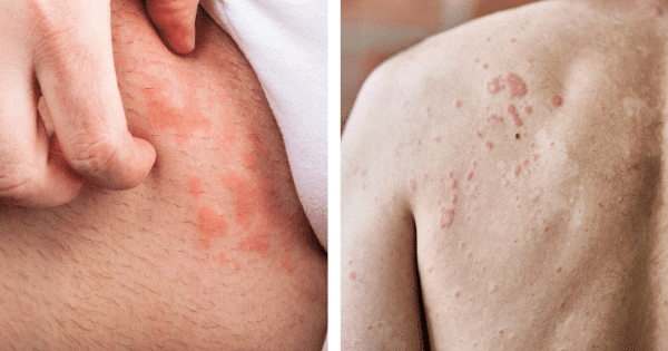 Cold Urticaria: Symptoms And Treatment Cold Urticaria: Symptoms And Treatment