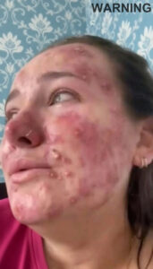 Her body was itching, I thought it was an allergy, they diagnosed ca…