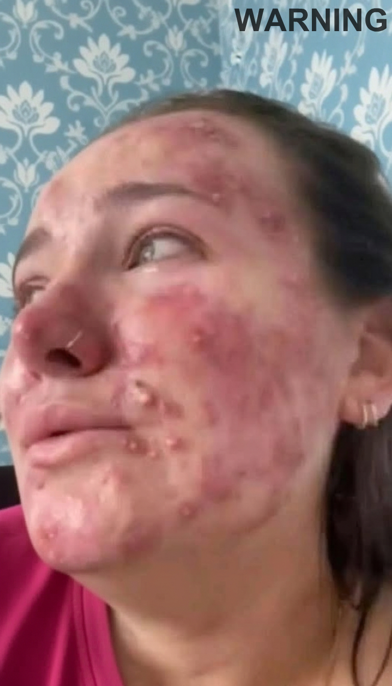 Her body was itching, I thought it was an allergy, they diagnosed ca…