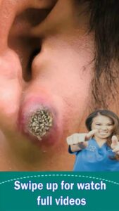This Facial Cyst Extraction Will Leave You Speechl℮ss