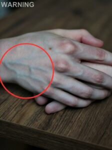 Assessing Liver Health Through Visible Hand Veins