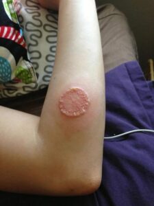 Clinical Case Study and Overview of Sweet Syndrome
