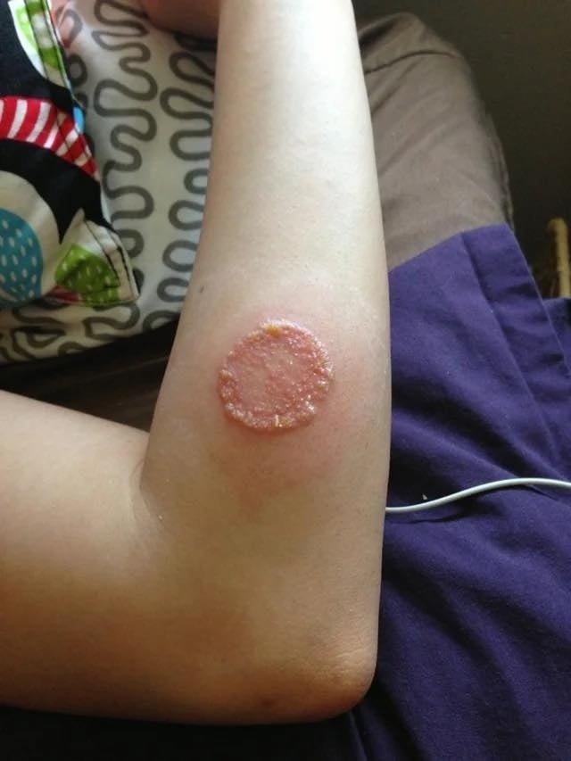 Clinical Case Study and Overview of Sweet Syndrome